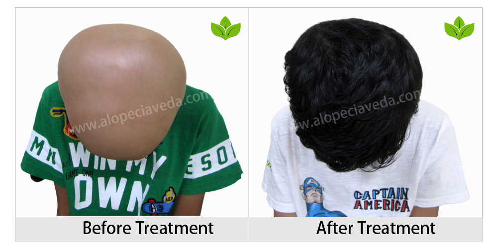 alopecia areata treatment