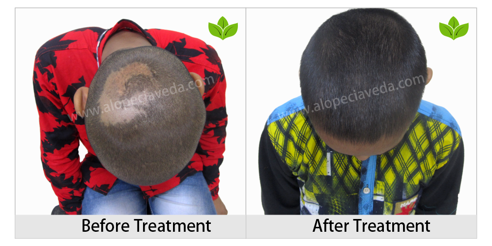 alopecia areata treatment