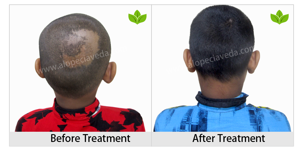 alopecia areata treatment