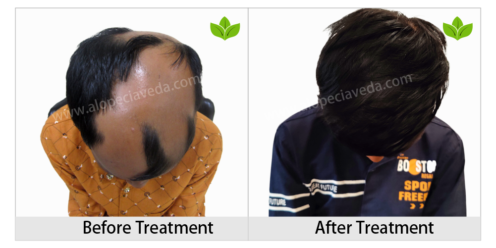 alopecia areata treatment