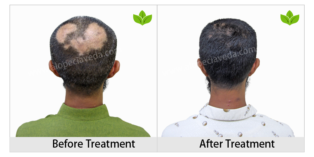 alopecia areata treatment